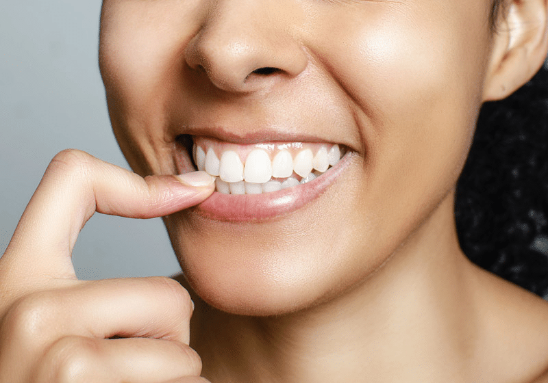 Imagen de sonrisa alineada.